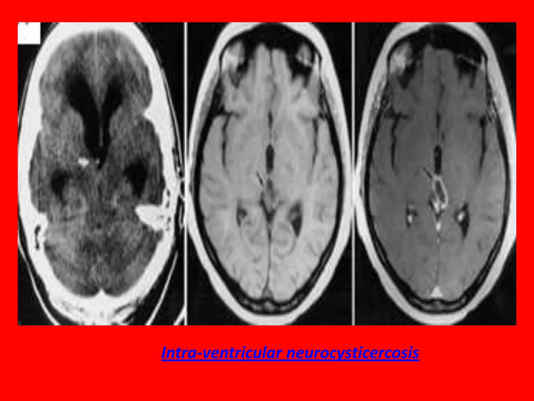Intra-ventricular neurocysticercosis

 