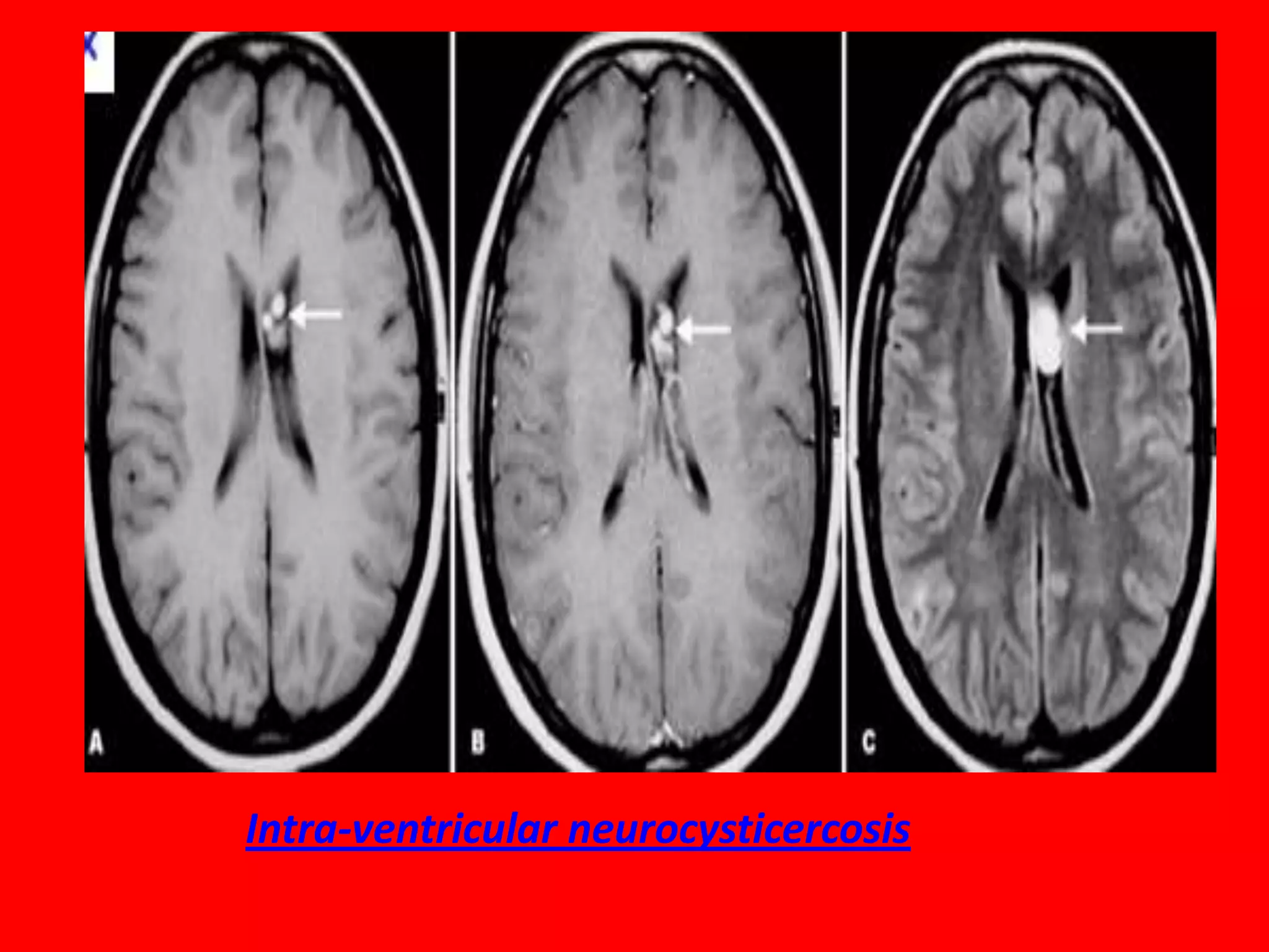 Intra-ventricular neurocysticercosis

 