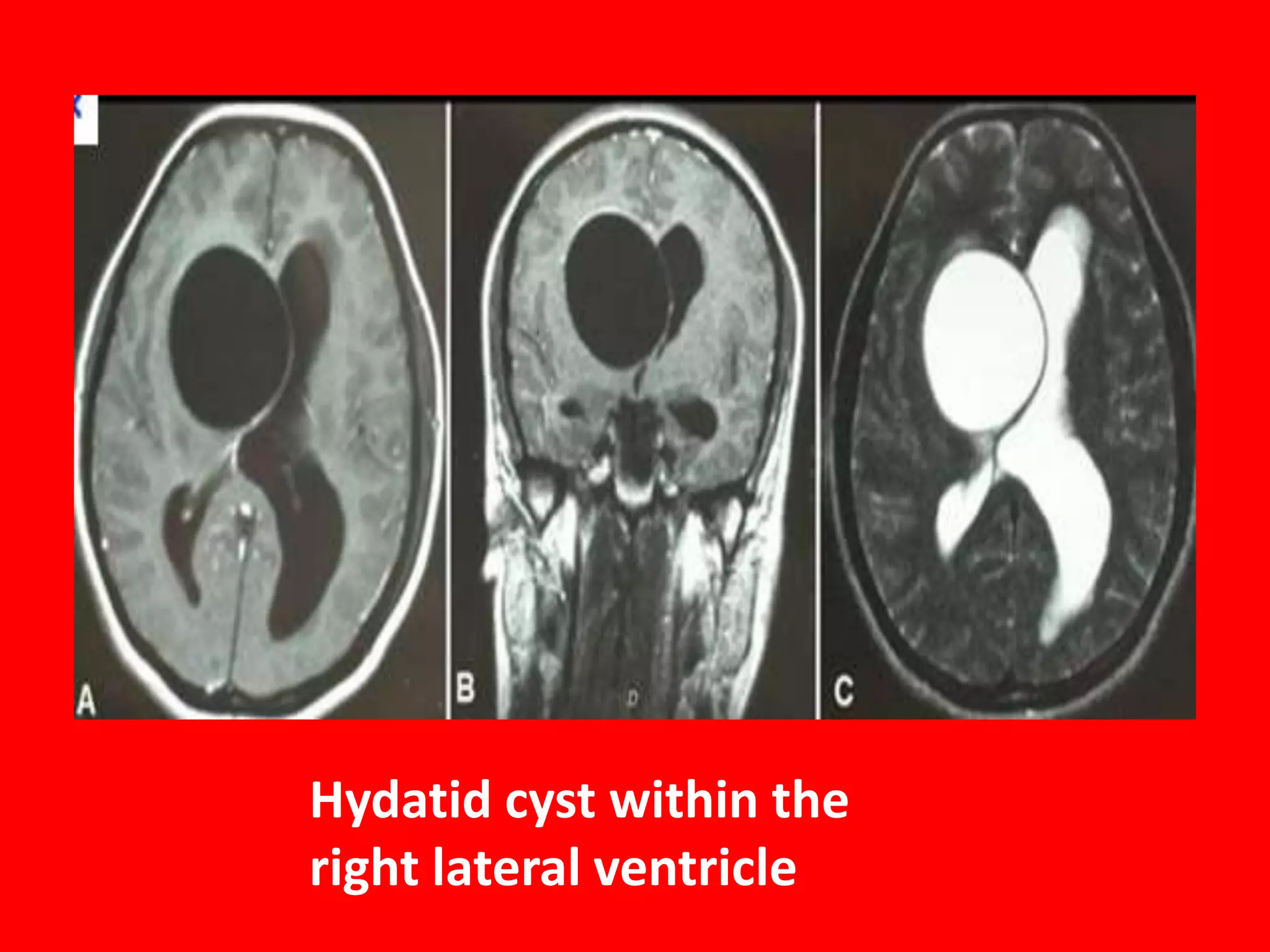 Hydatid cyst within the
right lateral ventricle

 