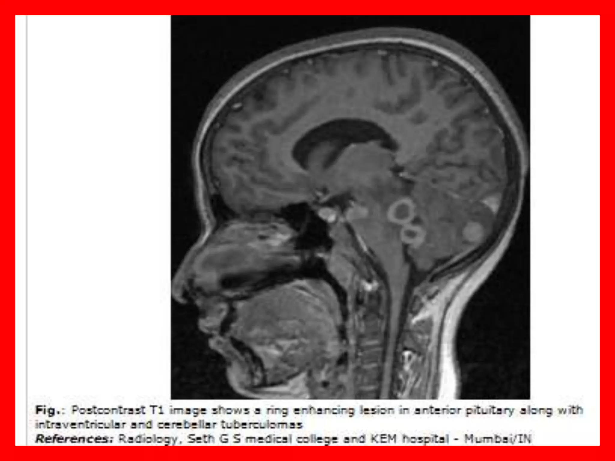 Presentation2.pptx , intra ventricular tumour and intra-cranial cyst