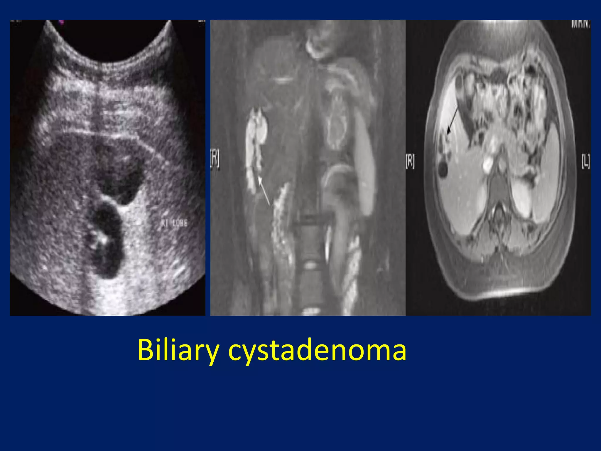 Biliary cystadenoma