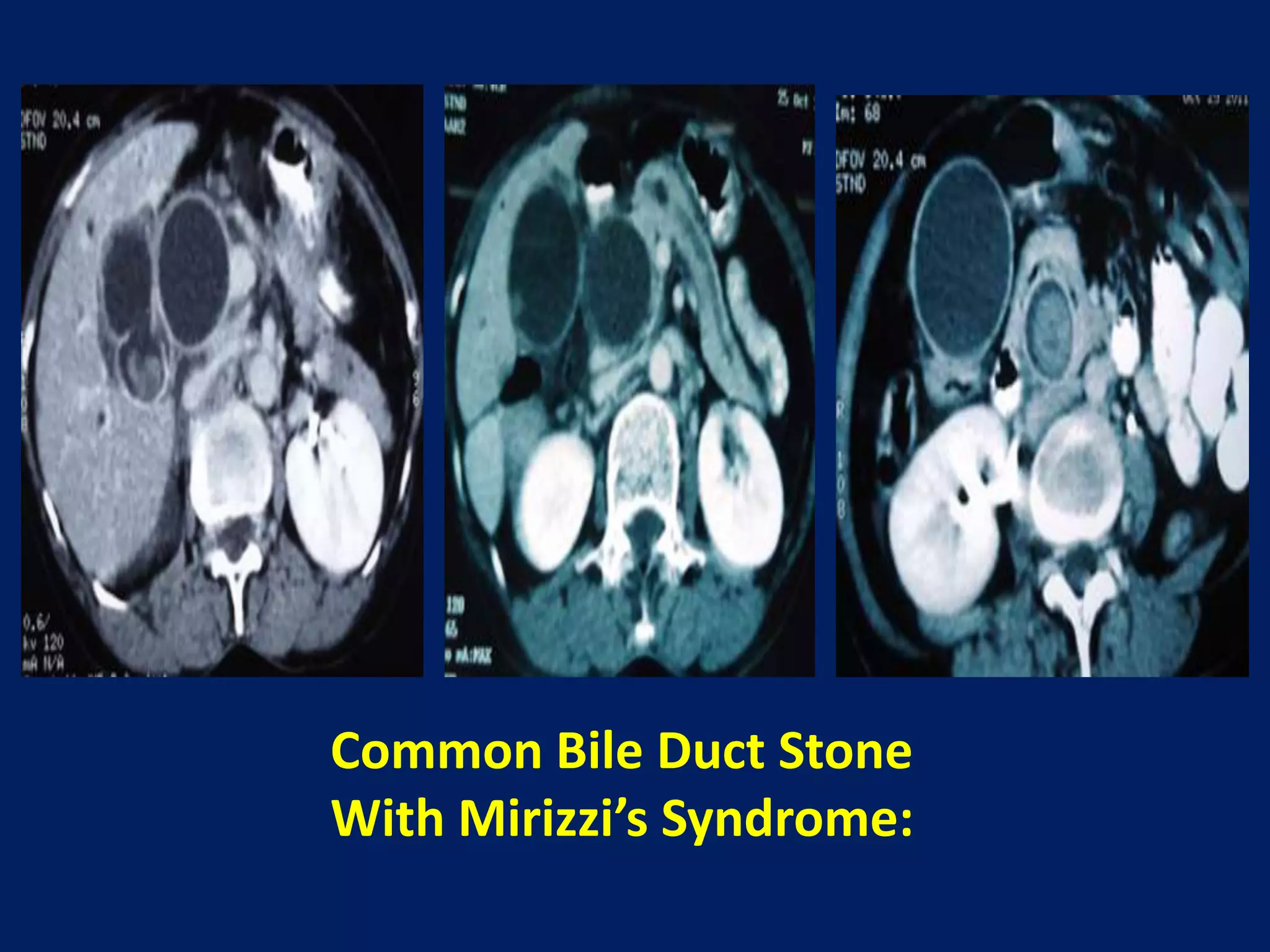 Common Bile Duct Stone
With Mirizzi’s Syndrome: