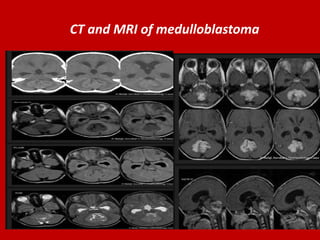 CT and MRI of medulloblastoma

 