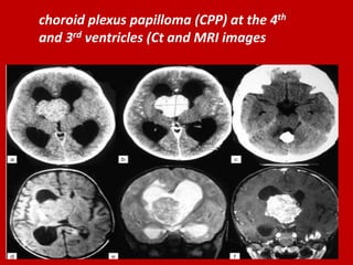 choroid plexus papilloma (CPP) at the 4th
and 3rd ventricles (Ct and MRI images

 