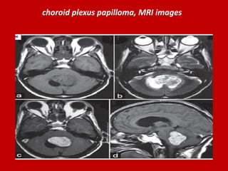 choroid plexus papilloma, MRI images

 