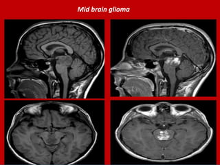 Mid brain glioma

 
