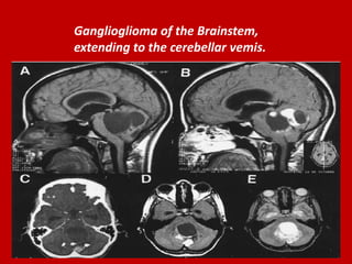 Ganglioglioma of the Brainstem,
extending to the cerebellar vemis.

 