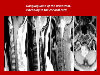 Ganglioglioma of the Brainstem,
extending to the cervical cord.

 