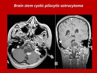 Brain stem cystic pilocytic astrocytoma.

 
