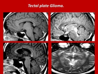 Tectal plate Glioma.

 