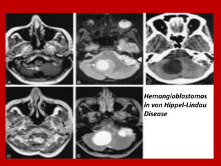 Hemangioblastomas
in von Hippel-Lindau
Disease

 