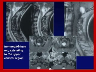 Hemangioblasto
ma, extending
to the upper
cervical region

 