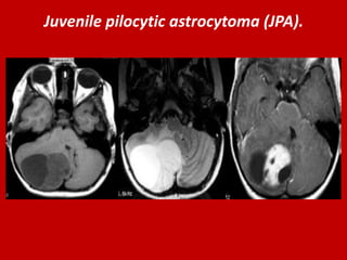 Juvenile pilocytic astrocytoma (JPA).

 