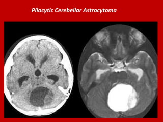 Pilocytic Cerebellar Astrocytoma

 
