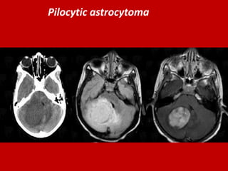 Pilocytic astrocytoma

 