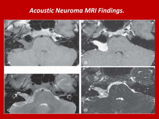 Acoustic Neuroma MRI Findings.

 