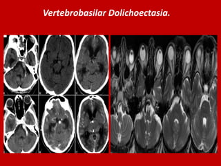Vertebrobasilar Dolichoectasia.

 
