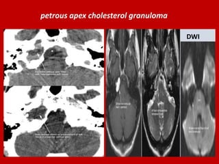 petrous apex cholesterol granuloma
DWI

 