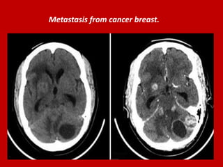 Metastasis from cancer breast.

 
