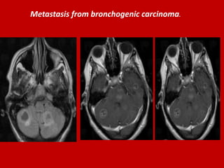 Metastasis from bronchogenic carcinoma.

 