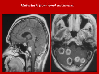 Metastasis from renal carcinoma.

 