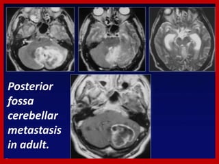 Posterior
fossa
cerebellar
metastasis
in adult.

 