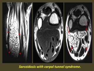 Sarcoidosis with carpal tunnel syndrome.
 
