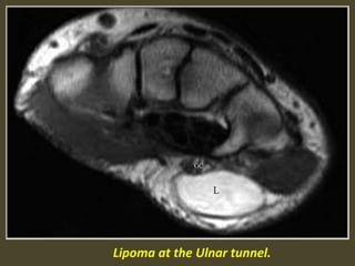 Lipoma at the Ulnar tunnel.
 