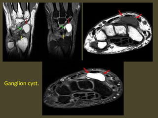Ganglion cyst.
 