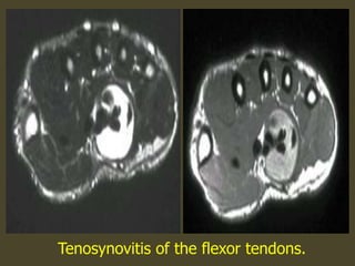 Tenosynovitis of the flexor tendons.
 