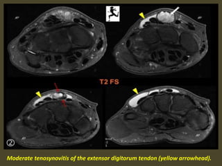 Moderate tenosynovitis of the extensor digitorum tendon (yellow arrowhead).
 