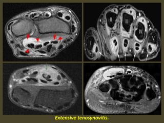 Extensive tenosynovitis.
 
