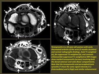 Tenosynovitis in a 32-year-old woman with early
rheumatoid arthritis of the wrist (5 months duration)
and normal radiographic findings. Axial T1-weighted
(a), fat-suppressed T2-weighted (b), and contrast-
enhanced fat-suppressed T1-weighted (c) MR images
show marked tenosynovitis (arrows) involving both
the dorsal extensor and volar flexor compartments.
Note that the tenosynovitis and periscaphoid joint
synovitis (*) have the same signal intensity in a
(intermediate) and b (high) and similar enhancement
 