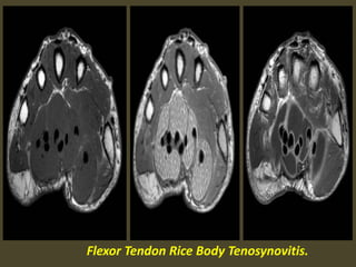 Flexor Tendon Rice Body Tenosynovitis.
 