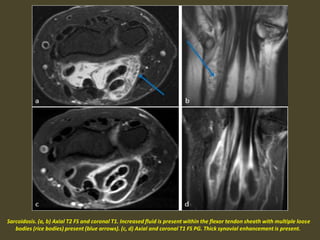 Sarcoidosis. (a, b) Axial T2 FS and coronal T1. Increased fluid is present within the flexor tendon sheath with multiple loose
bodies (rice bodies) present (blue arrows). (c, d) Axial and coronal T1 FS PG. Thick synovial enhancement is present.
 