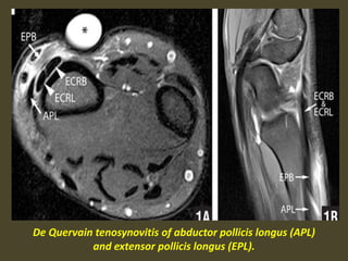De Quervain tenosynovitis of abductor pollicis longus (APL)
and extensor pollicis longus (EPL).
 