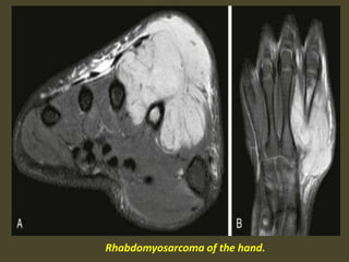 Rhabdomyosarcoma of the hand.
 
