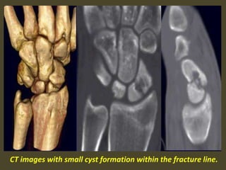CT images with small cyst formation within the fracture line.
 