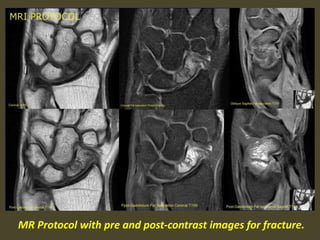 MR Protocol with pre and post-contrast images for fracture.
 