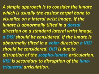 A simple approach is to consider the lunate
which is usually the easiest carpal bone to
visualize on a lateral wrist image. If the
lunate is abnormally tilted in a dorsal
direction on a standard lateral wrist image,
a DISI should be considered. If the lunate is
abnormally tilted in a volar direction a VISI
should be considered. DISI is due to
disruption of the scapho-lunate articulation.
VISI is secondary to disruption of the luno-
triquetral articulation.
 