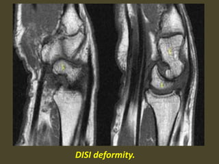 DISI deformity.
 
