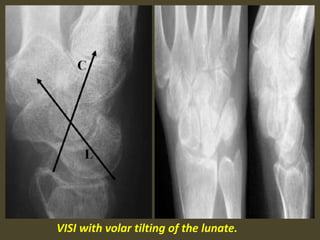 VISI with volar tilting of the lunate.
 
