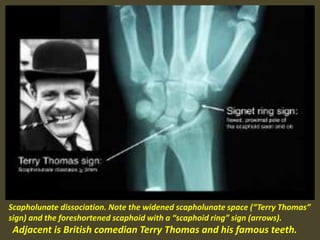 Scapholunate dissociation. Note the widened scapholunate space (“Terry Thomas”
sign) and the foreshortened scaphoid with a “scaphoid ring” sign (arrows).
Adjacent is British comedian Terry Thomas and his famous teeth.
 