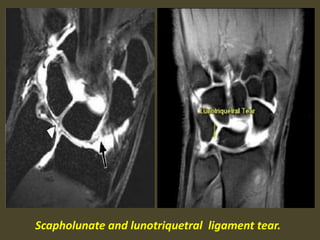 Scapholunate and lunotriquetral ligament tear.
 