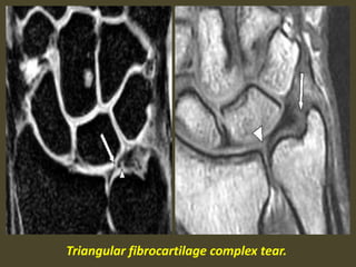 Triangular fibrocartilage complex tear.
 