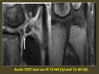 Acute TFCC tear on FS T2-WI (A) and T1-WI (B).
 
