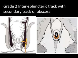 Presentation2.pptx peri anal fistula | PPTX
