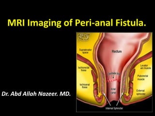 MRI Imaging of Peri-anal Fistula.
Dr. Abd Allah Nazeer. MD.
 