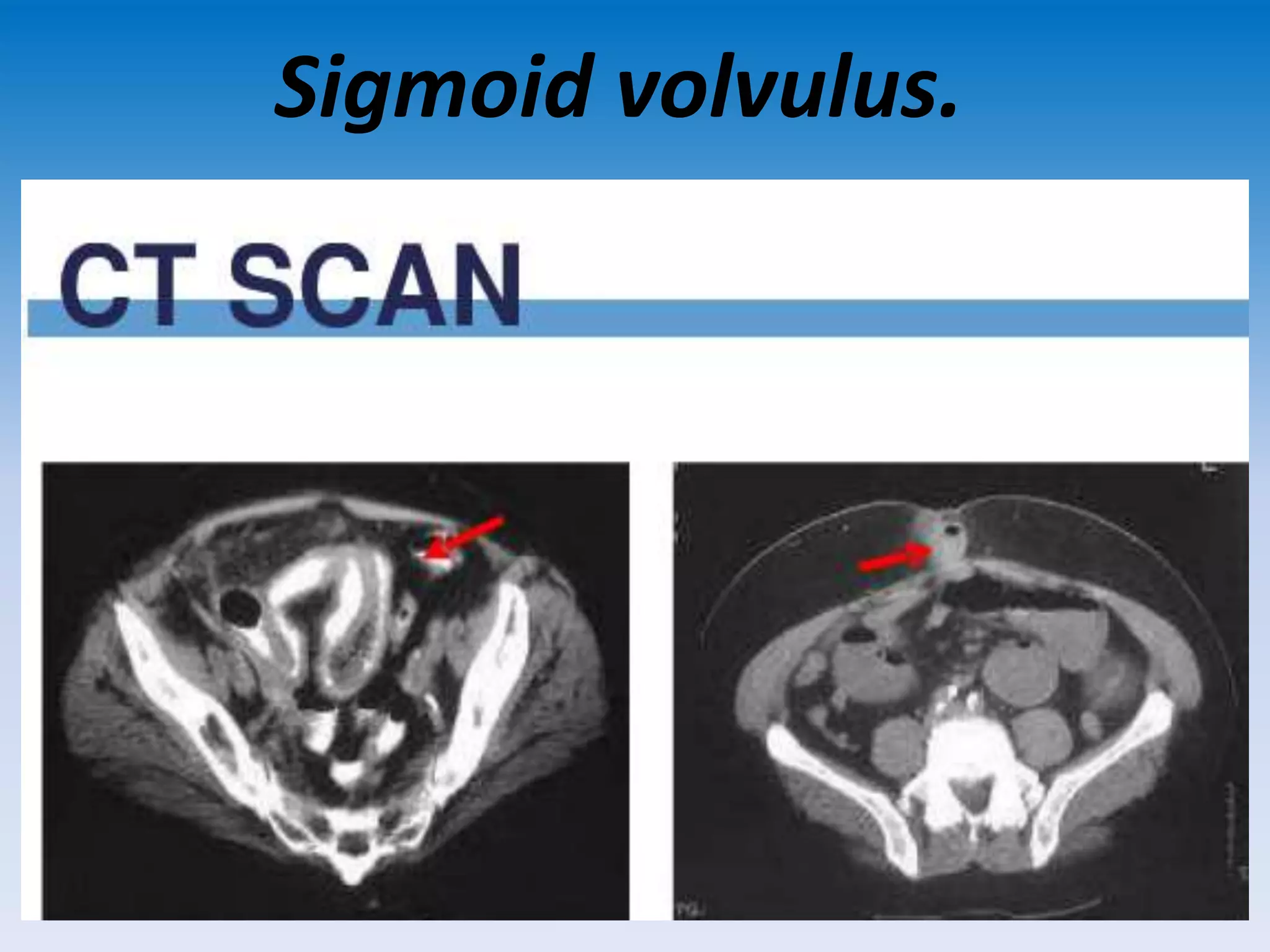 Sigmoid volvulus.