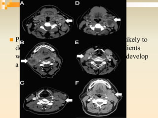  Patients with matted nodes were more likely to
develop distant metastases, whereas patients
with normal nodes were more likely to develop
a local recurrence
 